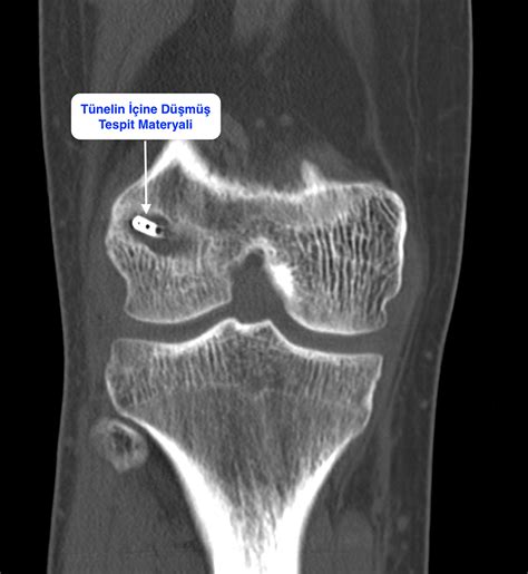 edgar michael eufemio|Revision Anterior Cruciate Ligament (ACL) Reconstruction.